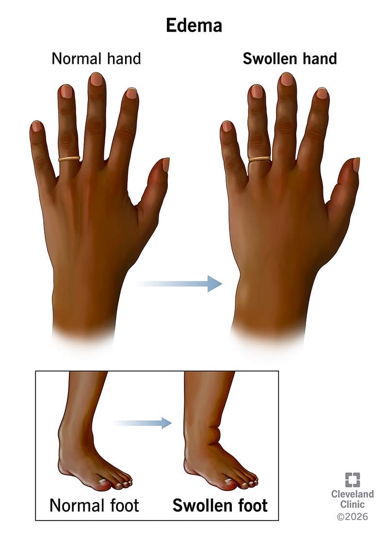 A close-up image of a vape device with a visibly swollen or bulging casing, indicating a damaged and potentially dangerous lithium-ion battery requiring careful handling.